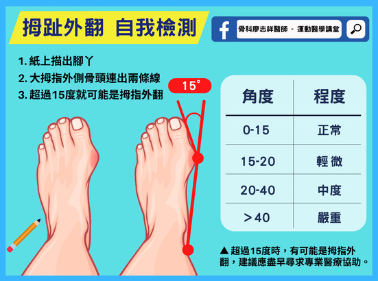 骨科廖志祥醫師解說醫學上定義「拇趾外翻」需要測量腳趾骨頭之間的角度。當拇趾外翻角度（HV）> 15 度，第一蹠骨和第二蹠骨間的角度（IMA）> 9 度時，就稱為「拇趾外翻」。(Photo by health.ltn.com.tw)