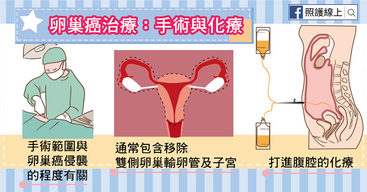 Ovarian cancer 45 歲從未生育女性患卵巢癌風險高！腹部腫脹或疼痛應及早檢查