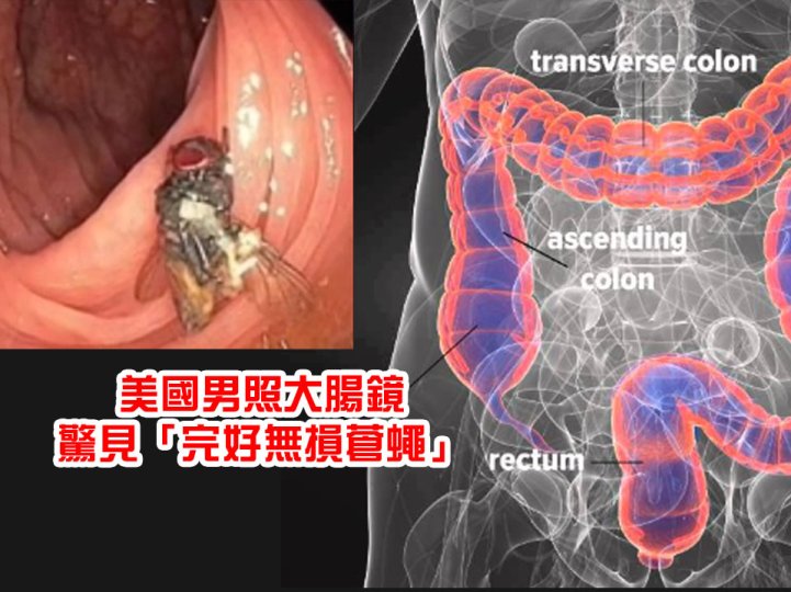 Fly 男子照大腸鏡  驚見原隻活生生蒼蠅  或誤吞卵致肚內孵化