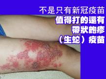 Shingles 如果你年過 50 要打帶狀皰疹（生蛇）疫苗