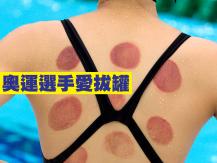 Cupping 奧運選手愛拔罐 