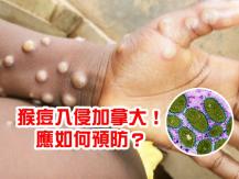 Monkeypox 猴痘入侵加拿大！ 致命率高達 10% 應如何預防？