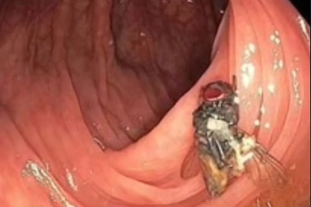 美國密蘇里州出現一宗驚人病例，一名男子接受例行性大腸鏡檢查時，竟被發現腸道裡有一隻活生生的蒼蠅。(Photo by Dailymail @ TikTok)