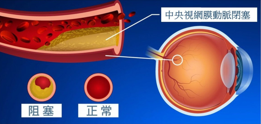 視網膜動脈閉塞（俗稱眼中風）是十分罕見但對視力有嚴重損害的眼疾。中央視網膜動脈閉塞，是指供應整個視網膜的動脈閉塞，患者會出現嚴重的急性視力模糊。(Photo by ovs.cuhk.edu.hk)