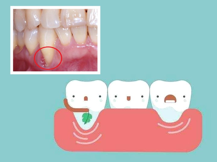 Dental Health 4 月「牙齒健康月」刷牙不當小心牙齦萎縮！
