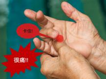 Trigger finger 手指彎曲就疼痛？ 你可能是患有「板機指」！1746054569