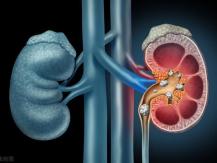 Kidney stone 營養師點名 4 類人易患腎結石1746054569